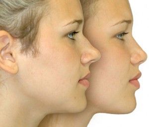 rhinoplastie tunisie